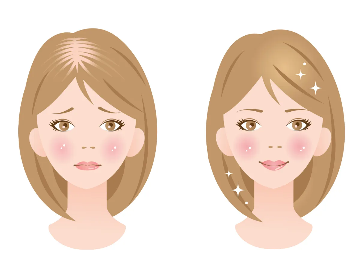女性の薄毛